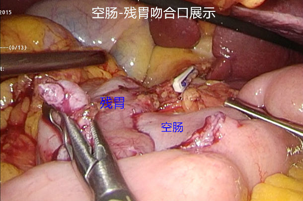 完全腹腔鏡下近端胃大部切除術雙通道消化道重建