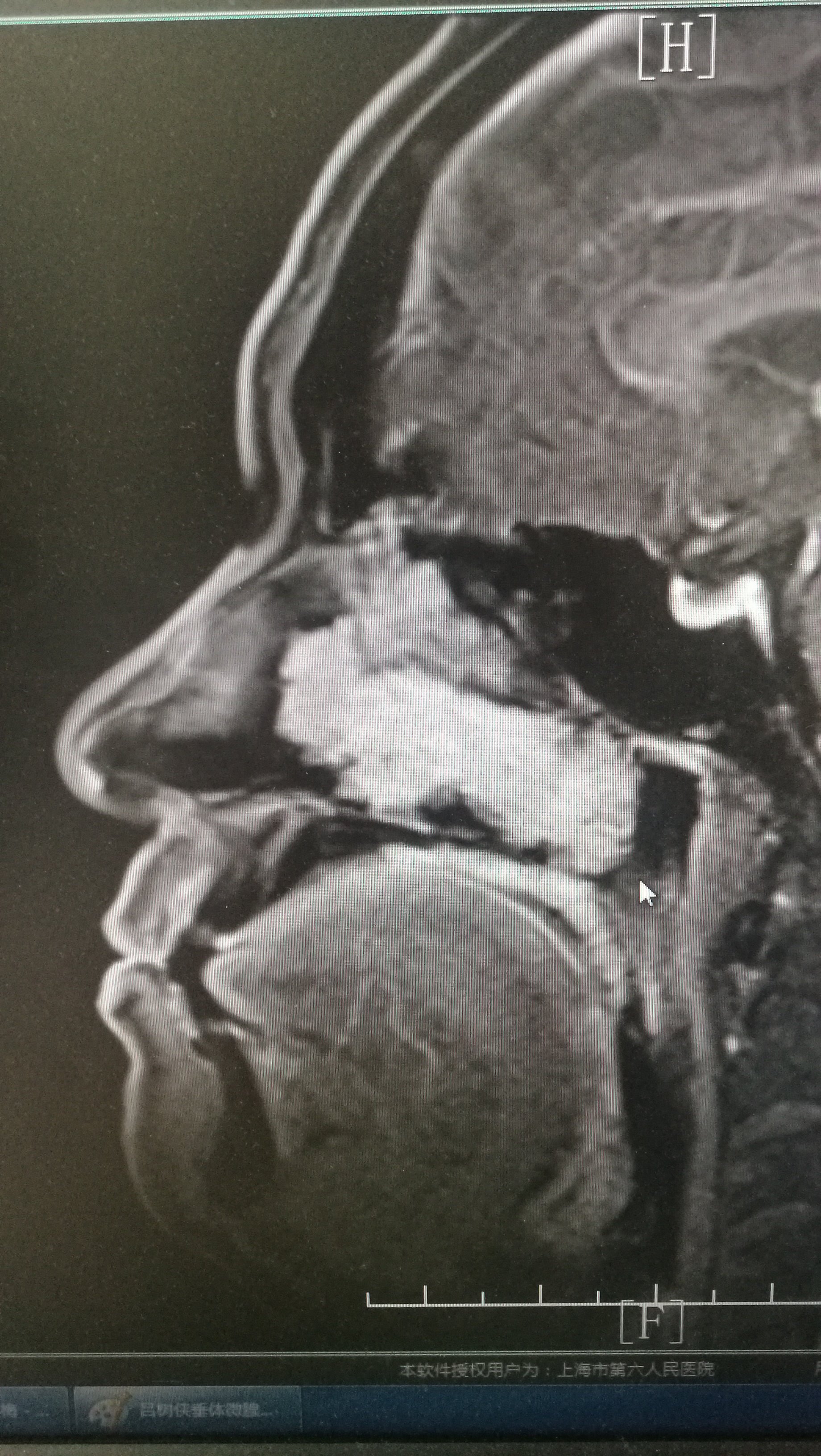 鼻窦骨瘤图片图片