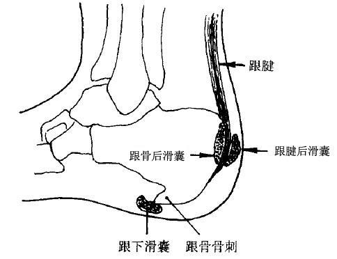 【病因和病理】①跟腱滑囊炎跟骨後方有全身最粗大的肌腱一一跟腱附著