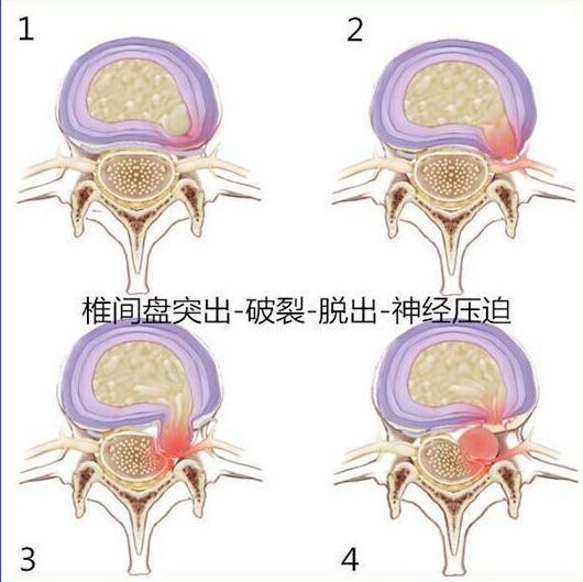 詳解腰椎間盤突出