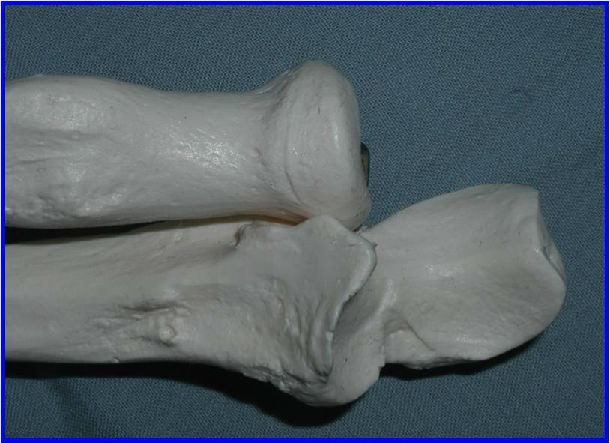 尺骨冠状突尺骨周围韧带桡骨周围韧带下图示受伤机制肘关节恐怖三联征