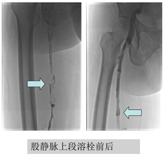 1531723628593187.png 股静脉上端溶栓前后.png