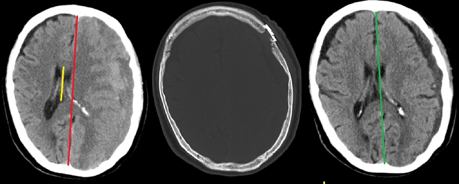 魏社鹏版医学百科--慢性硬膜下血肿