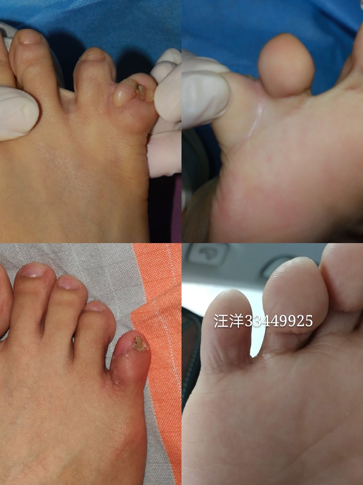 多趾,脚上多一个趾头,指头,六指,六趾,山大二院,汪洋