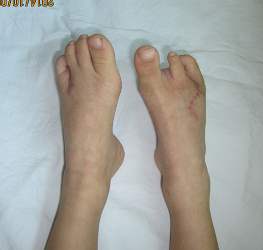 双足先天性畸形整形 - 好大夫在线