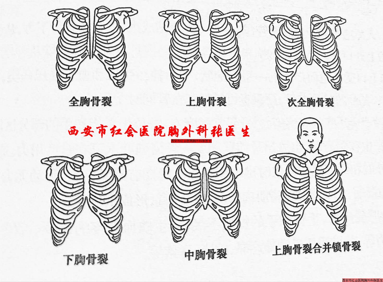 胸骨裂是什么什么表现怎样治疗