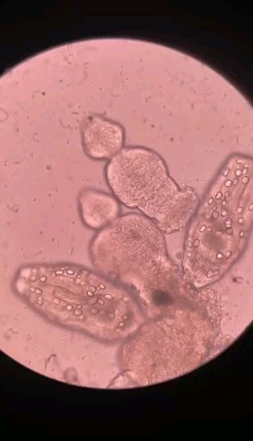 包虫病术中所见活的原头蚴 - 好大夫在线