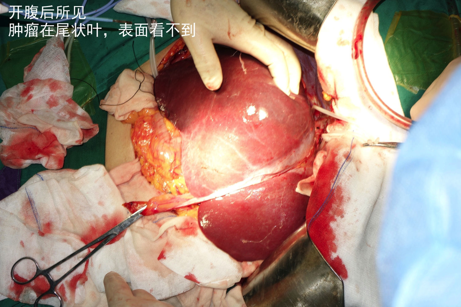 巨大尾状叶肝细胞肝癌切除术1例