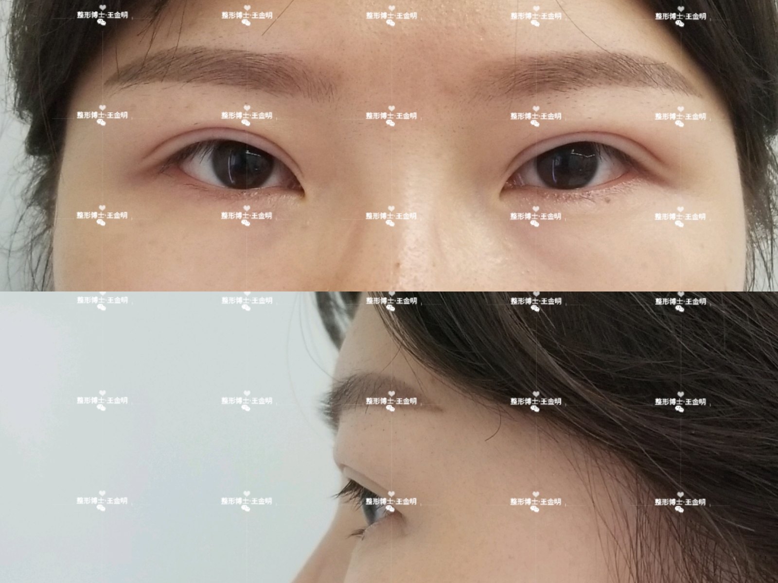 双眼皮修复价格_哪里有专业修复双眼皮的医院_双眼皮的修复