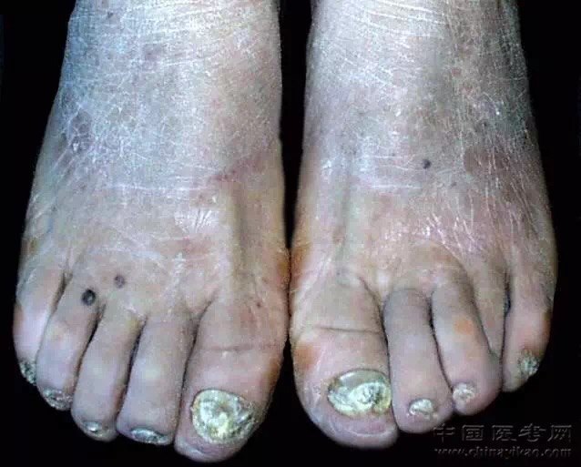 甲真菌病诊疗指南(2015)解读 - 好大夫在线