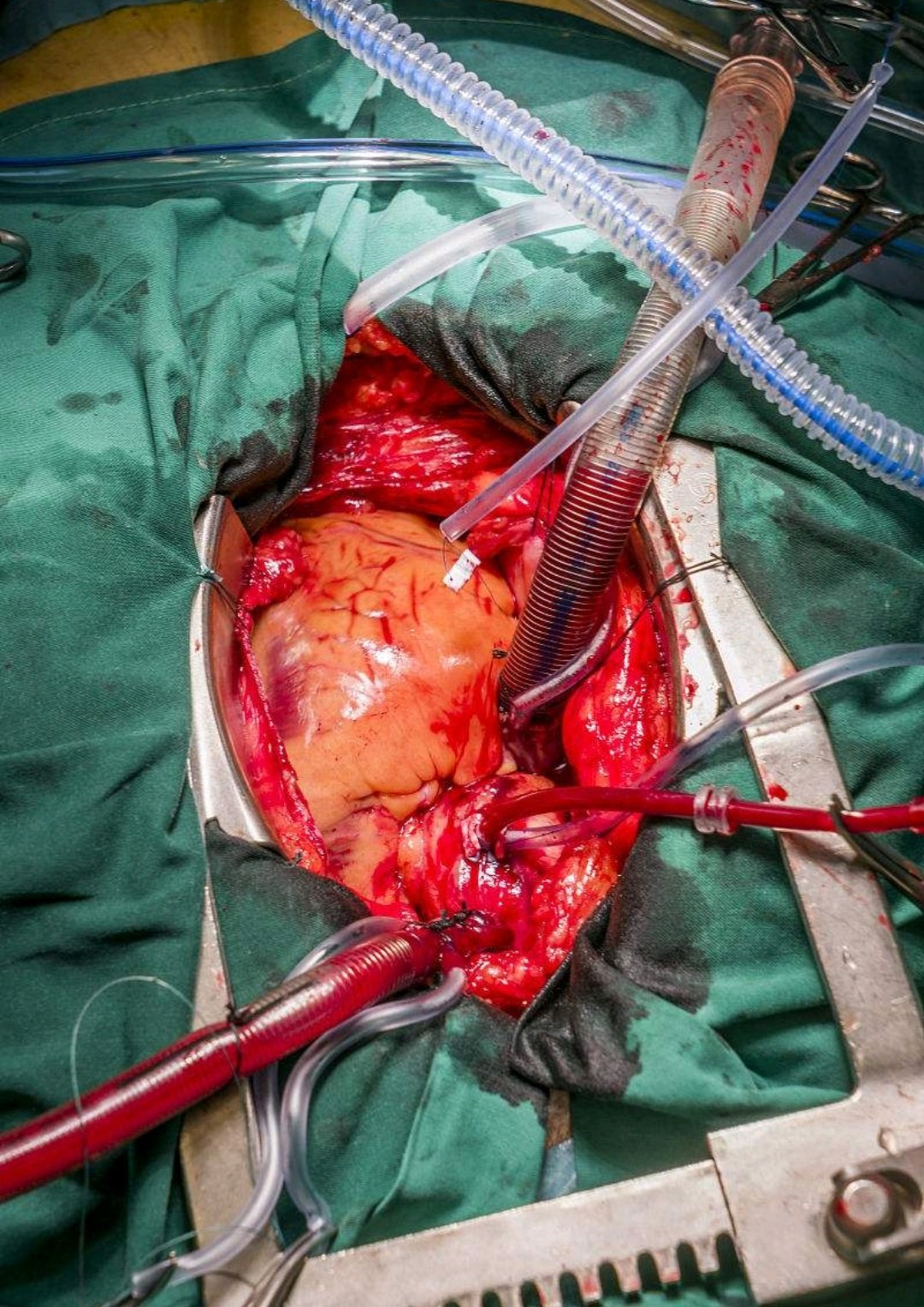 微创小切口换瓣手术治疗主动脉瓣关闭不全和狭窄