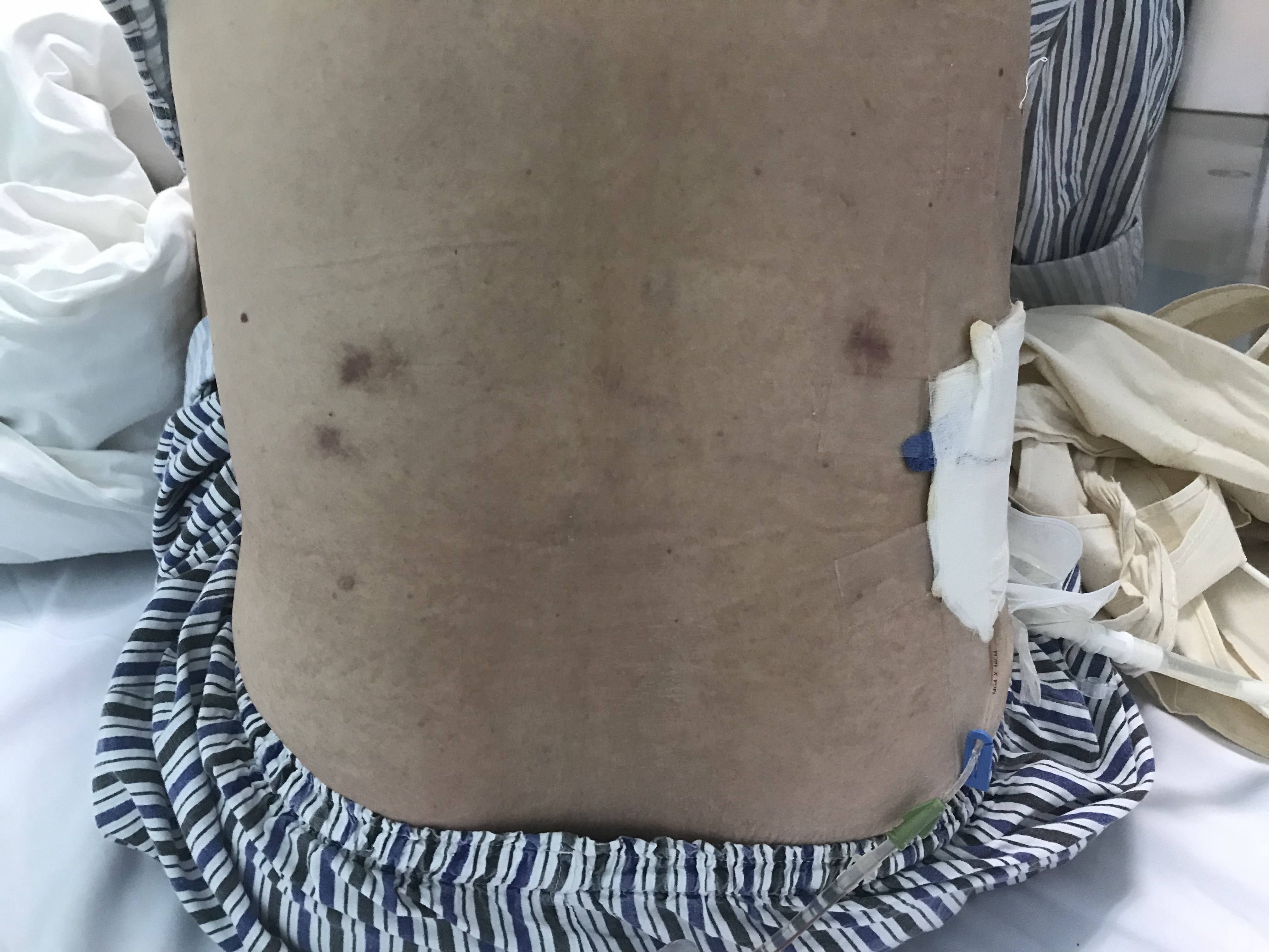 肾造痿可以摘掉摘袋专家在行动