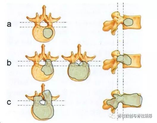 椎體血管瘤並不