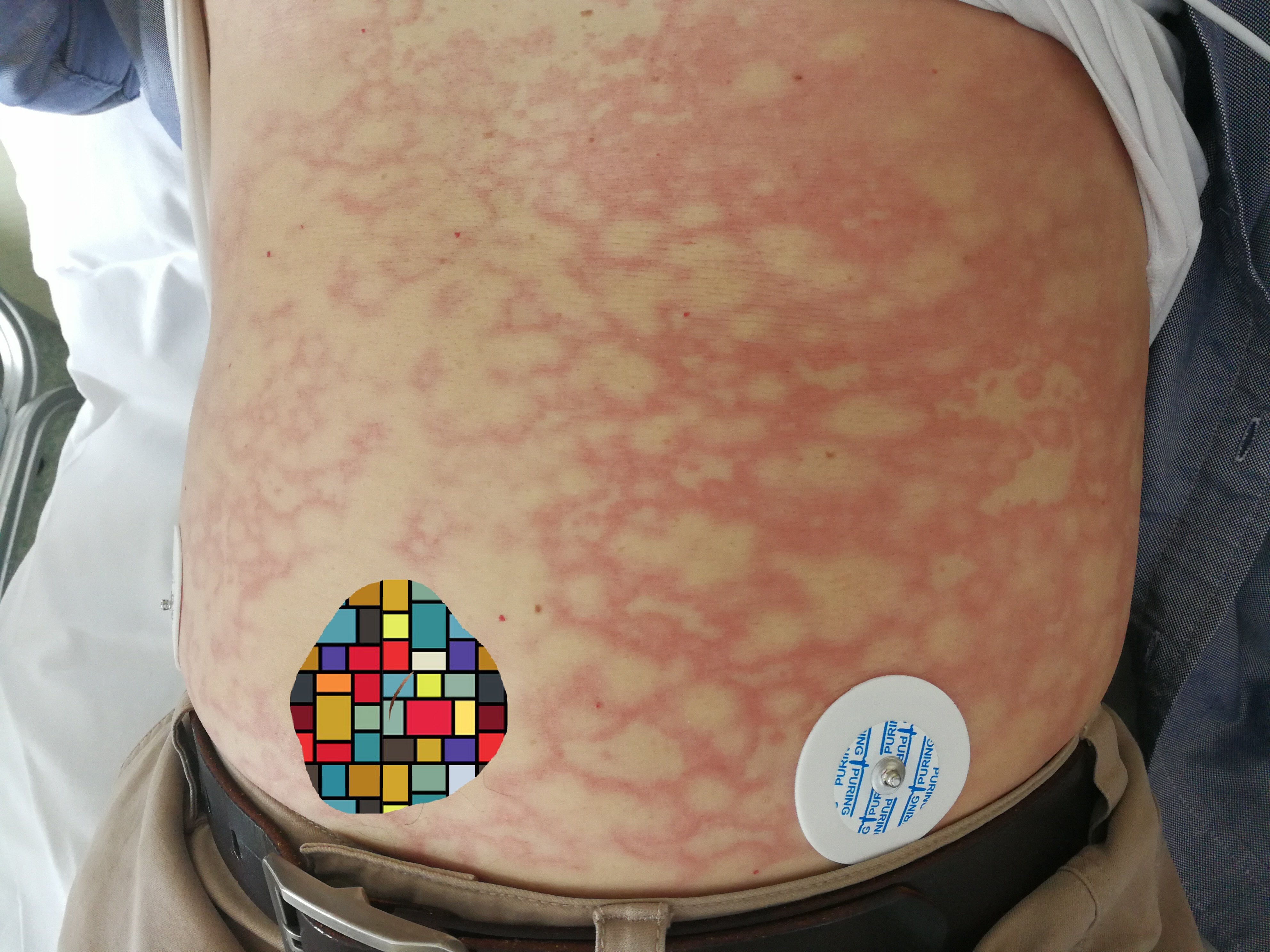 破伤风迟发性过敏