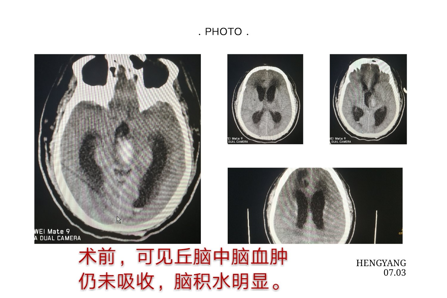 术中可见丘脑血肿压迫中脑导水管开口,清除血肿,并行三脑室底造瘘.