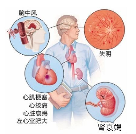 高血压可以不吃药吗?