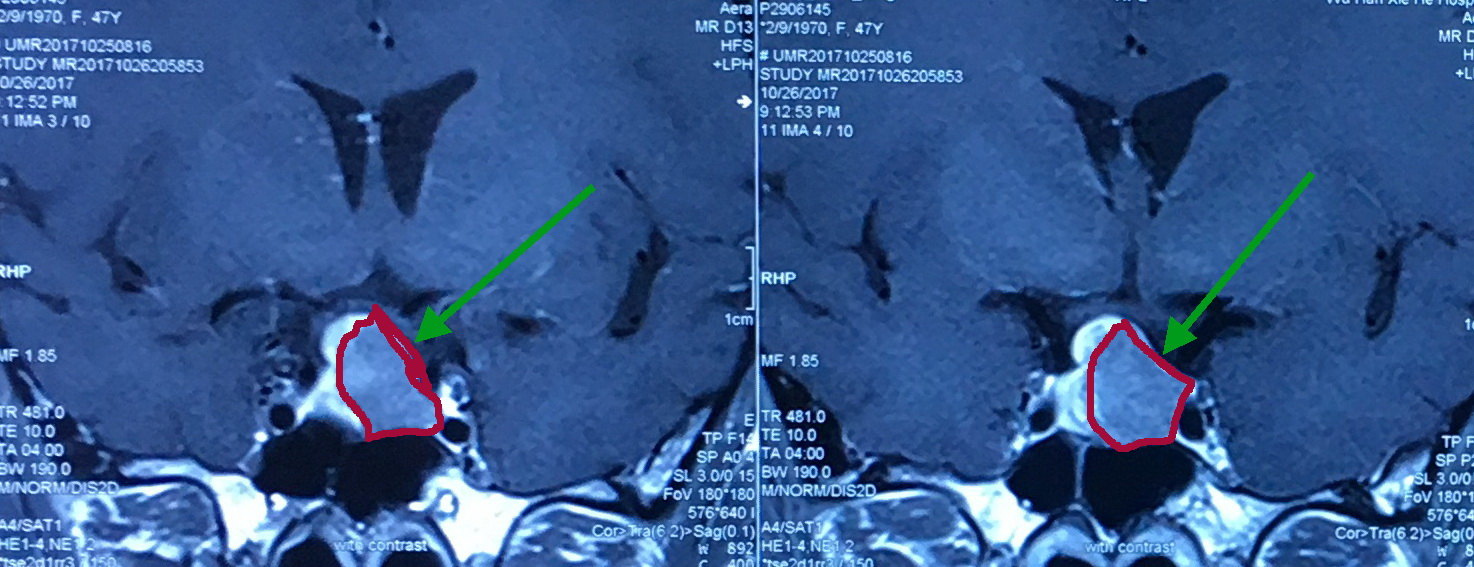 神經內鏡下全切除垂體大腺瘤一例