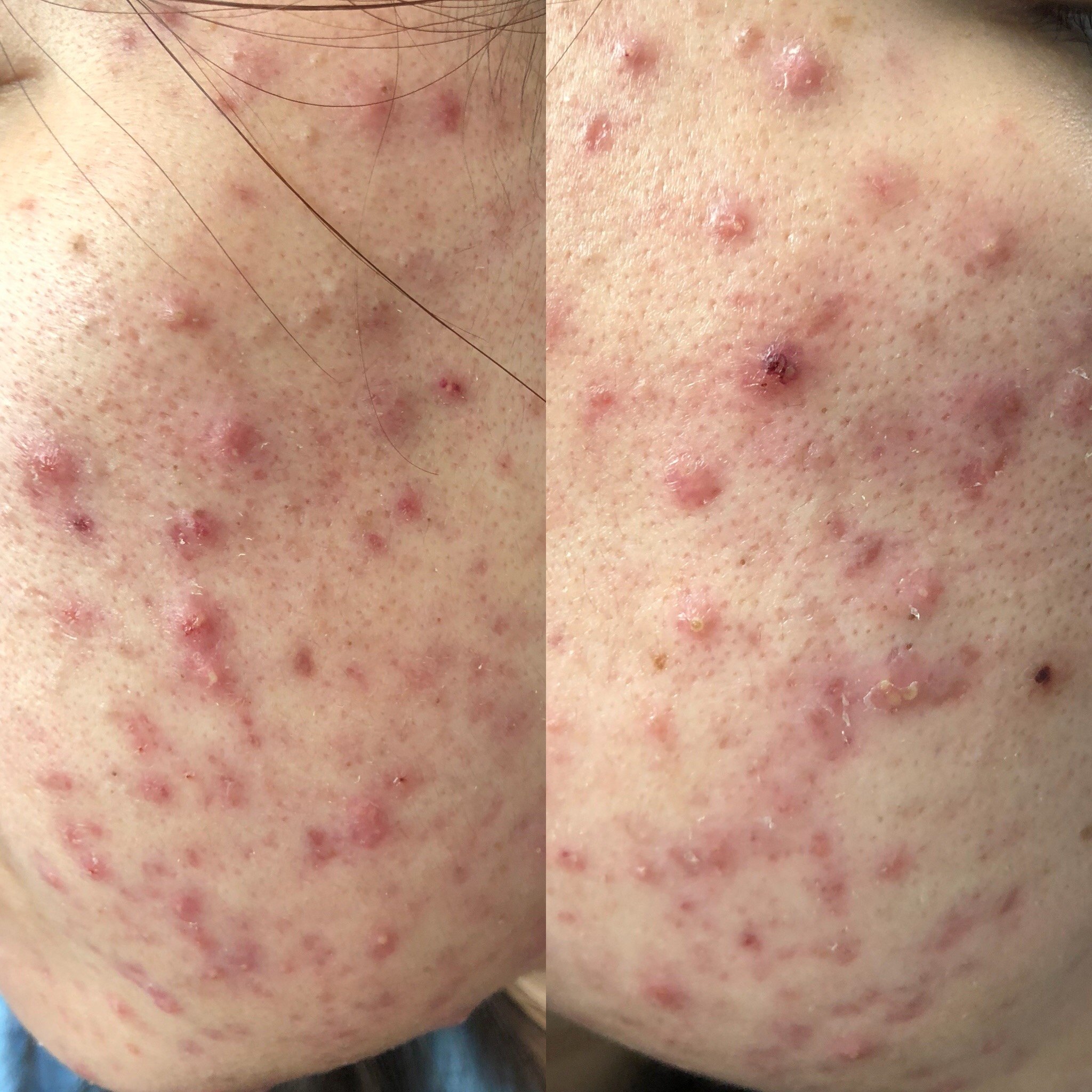 痤疮的分型痤疮专病11