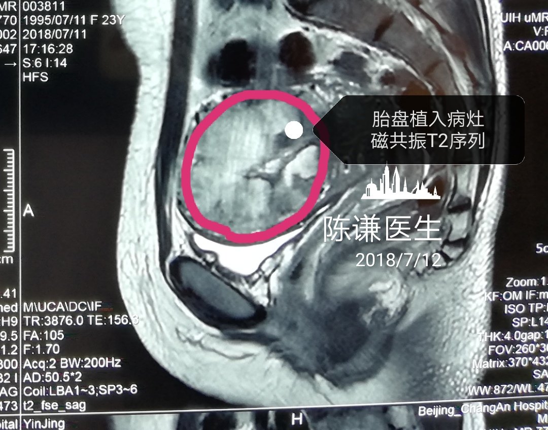 胎盤植入海扶手術保留子宮病歷分享