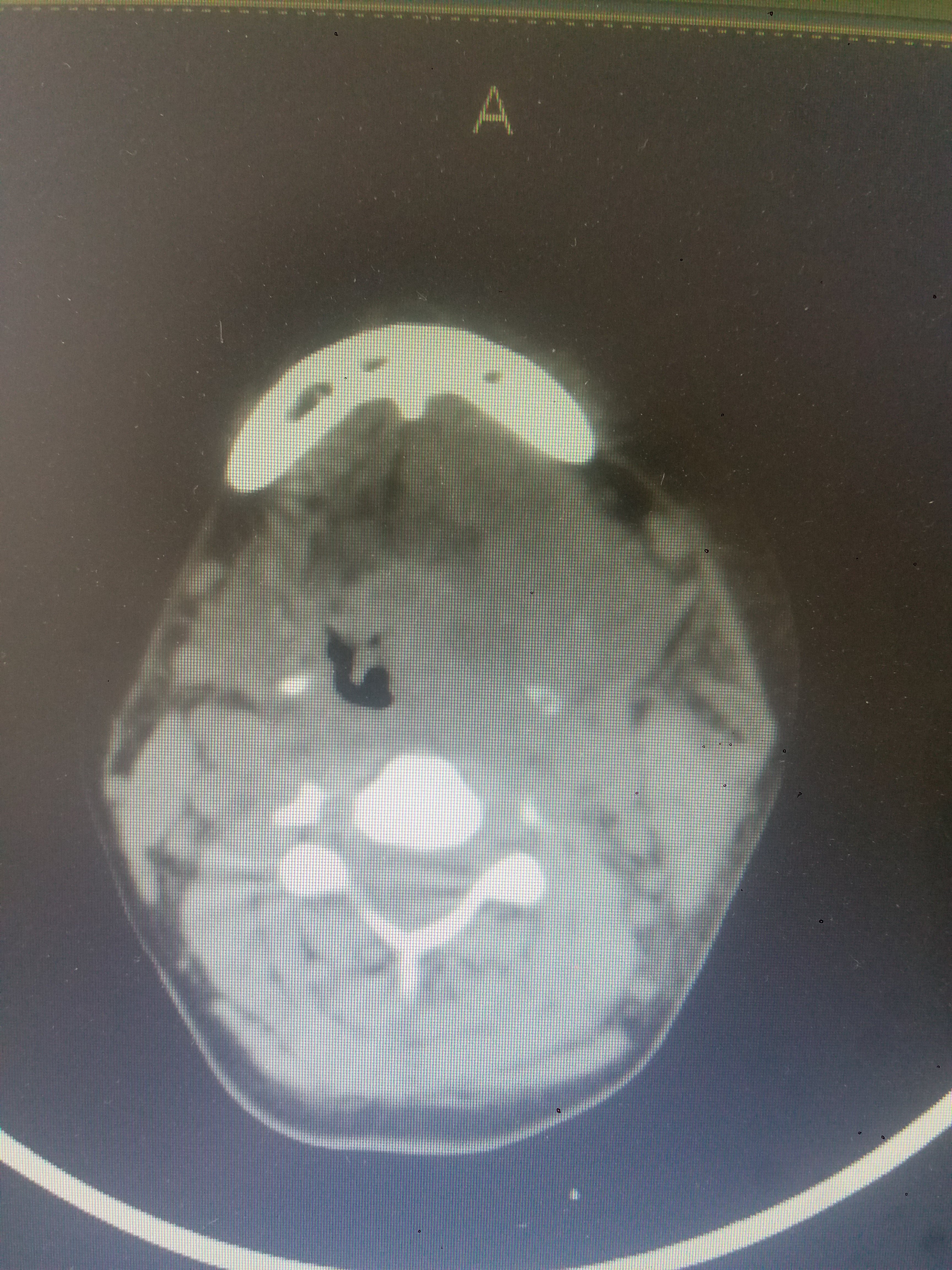 可怕的颌面颈部蜂窝组织炎 - 好大夫在线