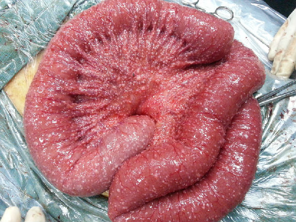 肠梗阻 腹腔结核 结核性腹膜炎 - 好大夫在线