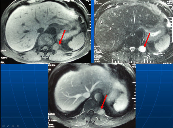 胸椎旁神经鞘瘤t11