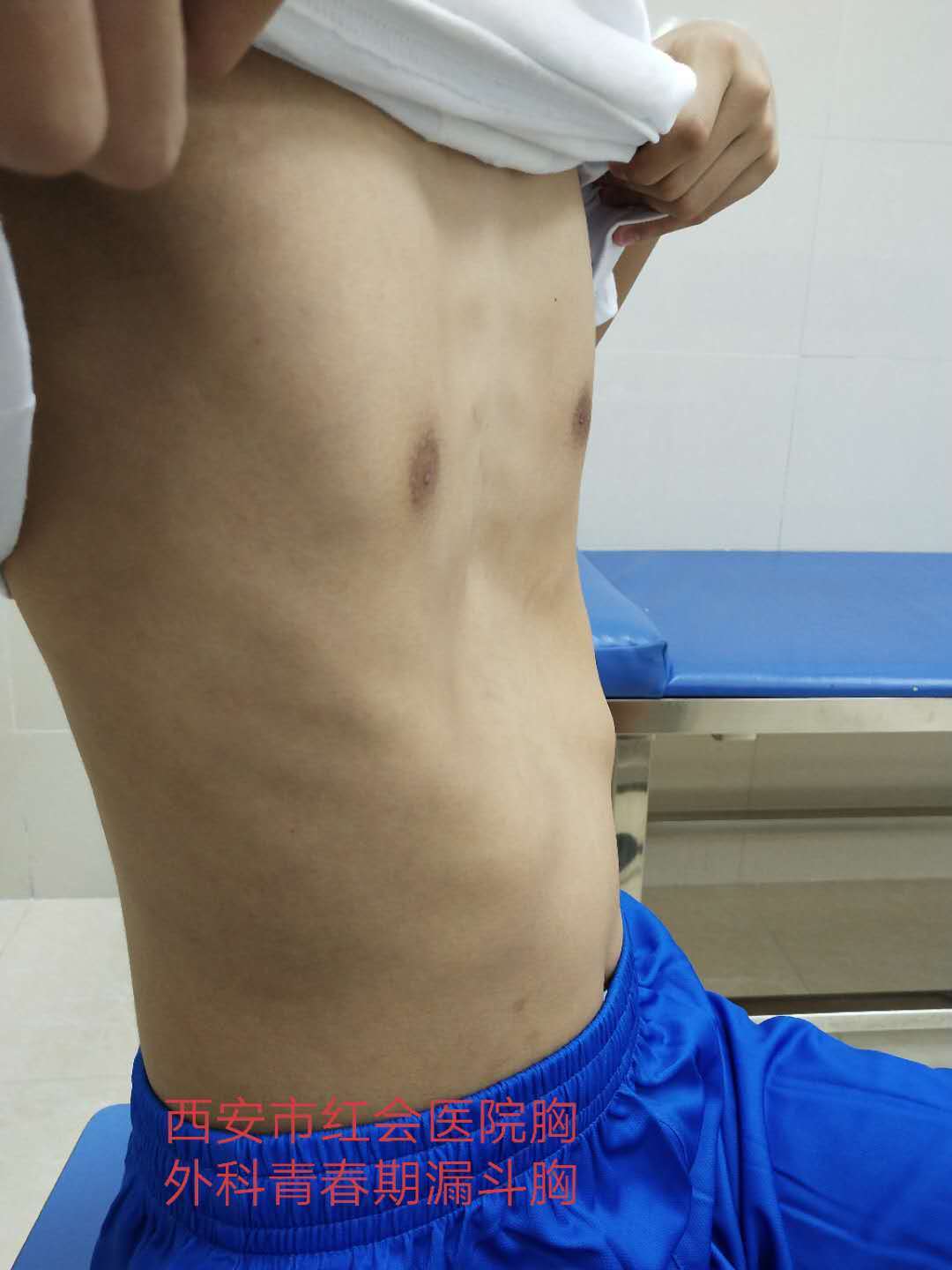 什么是胸廓崎形 漏斗胸有哪些危害 漏斗胸 疾病介绍 什么是胸廓崎形 漏斗胸有哪些危害 漏斗胸 疾病介绍