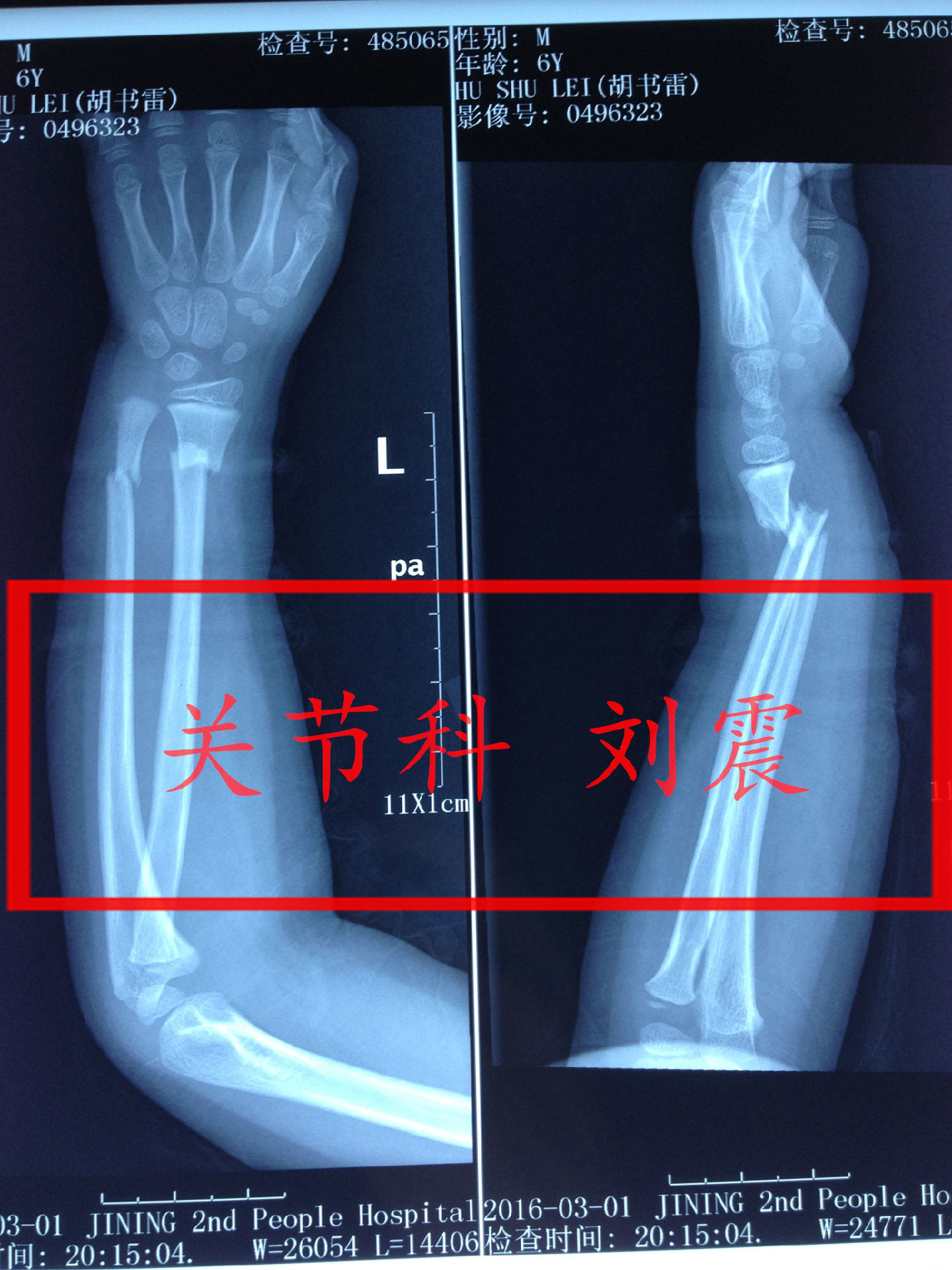 尺桡骨远端双骨折的手法整复治疗