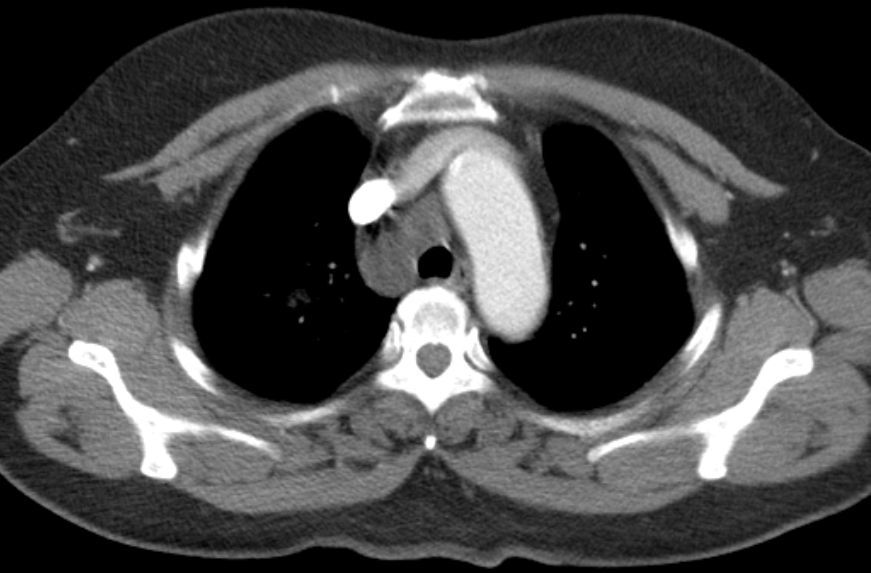 胸腺囊腫與胸腺瘤區別是什麼需要手術嗎thymiccyst