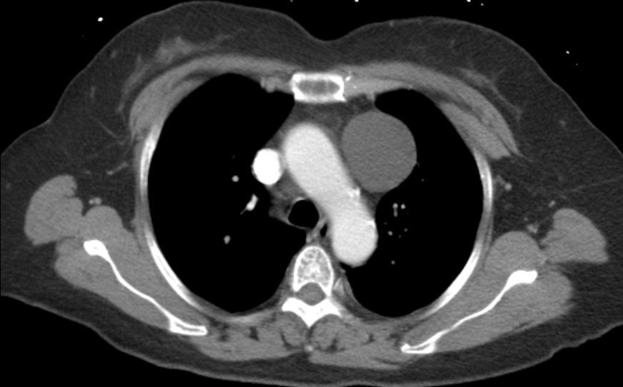 胸腺囊腫與胸腺瘤區別是什麼需要手術嗎thymiccyst