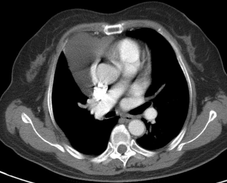 胸腺囊腫與胸腺瘤區別是什麼需要手術嗎thymiccyst