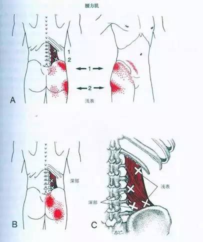 腰方肌损伤后可能引起疼痛的区域