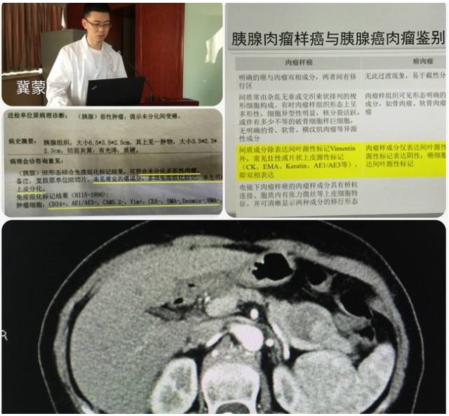 【MDT简讯】第20次上海长征医院胰胆肿瘤多