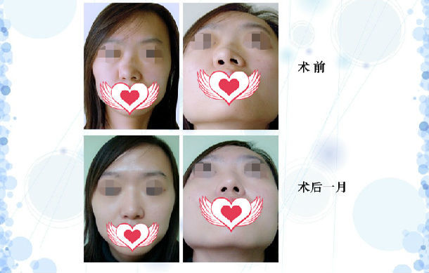 鼻骨,软骨严重偏右侧歪斜 手术方案:歪鼻矫正术,鼻尖抬高术 术后鼻梁