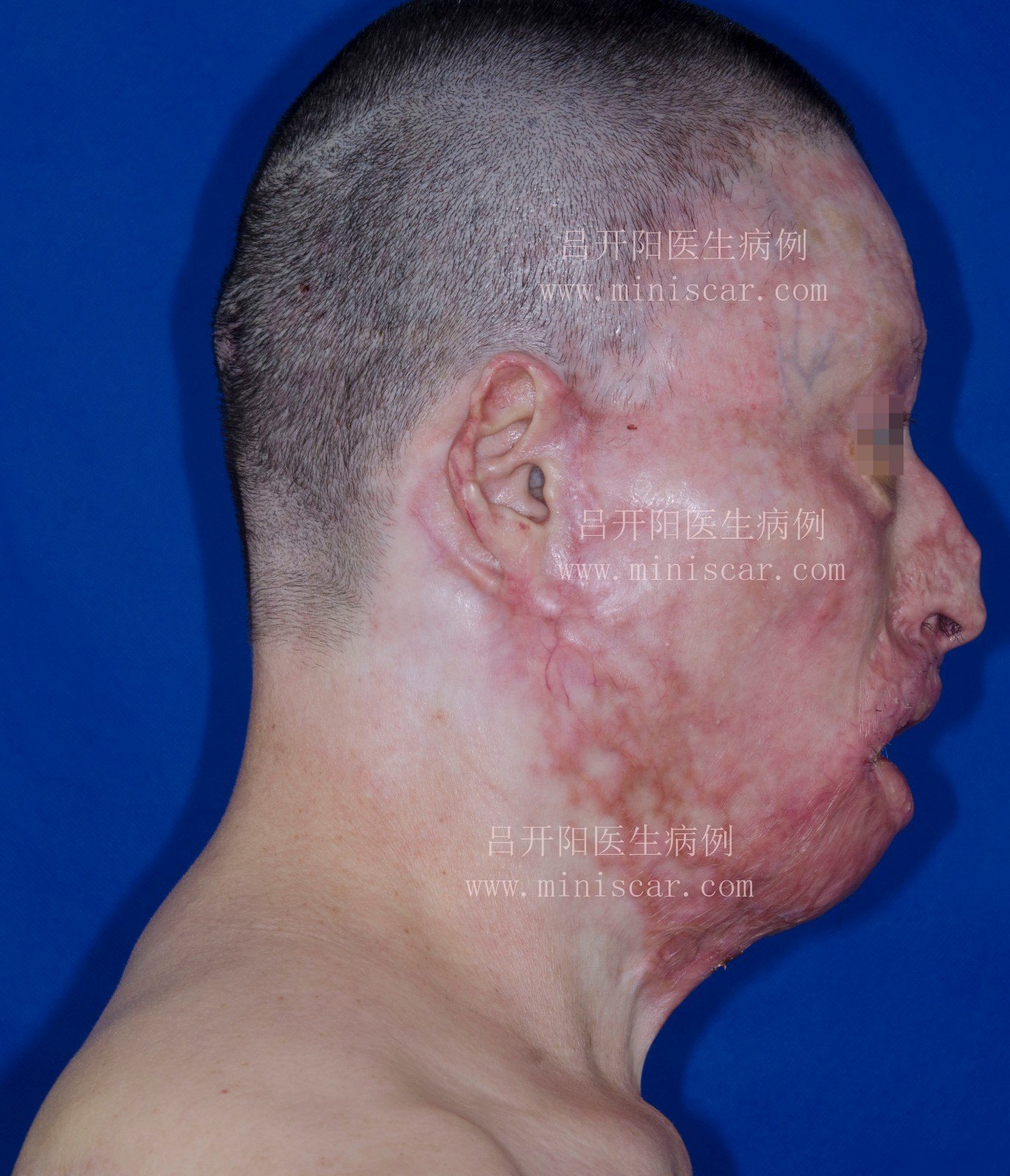 關于擅長:危重燒傷、復合傷救治,毀損性組織缺損和難愈合性創(chuàng)面修復、燒創(chuàng)傷后畸形整復。黃牛號販子掛號,圈子口碑最好100%有號!專業(yè)的人做專業(yè)的事的信息 關于擅長:危重燒傷、復合傷救治,毀損性組織缺損和難愈合性創(chuàng)面修復、燒創(chuàng)傷后畸形整復。黃牛號販子掛號,圈子口碑最好100%有號!專業(yè)的人做專業(yè)的事的信息