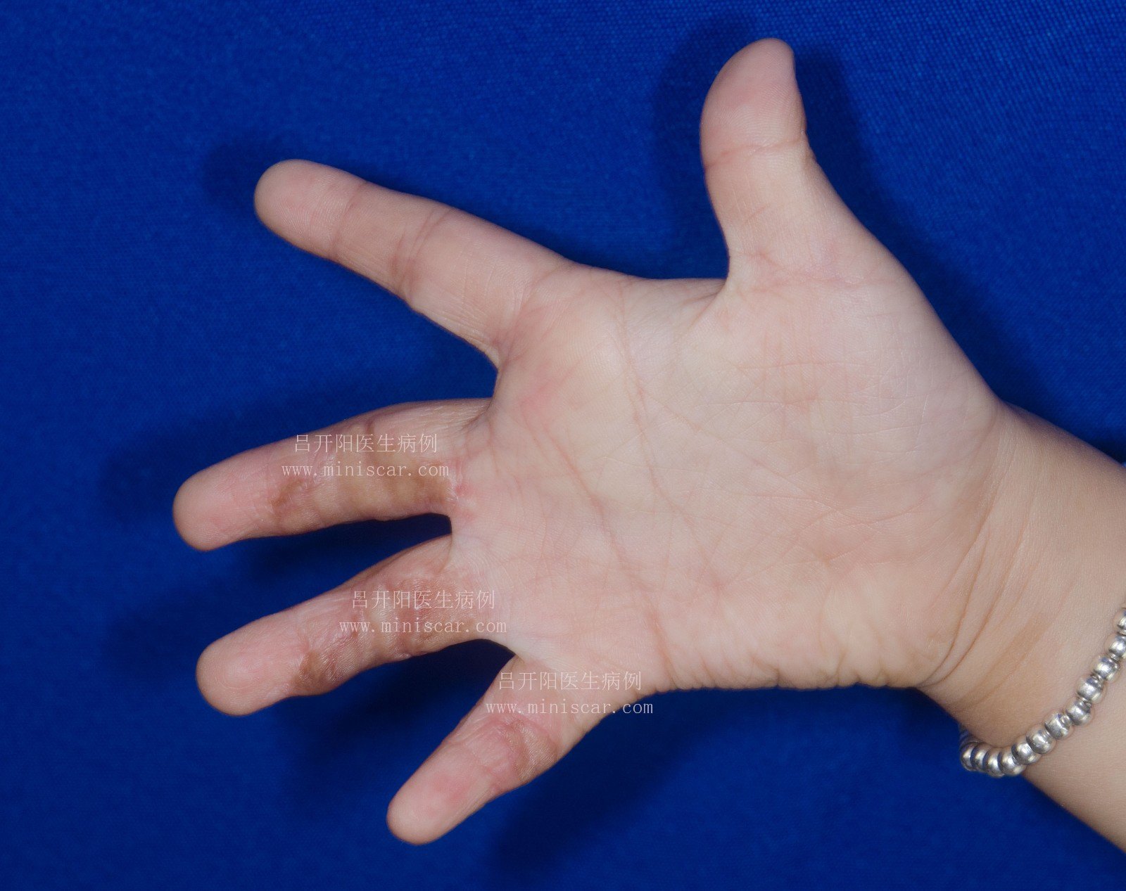 脫毛燙傷皮膚__手臂燙傷脫皮了會(huì)留疤嗎