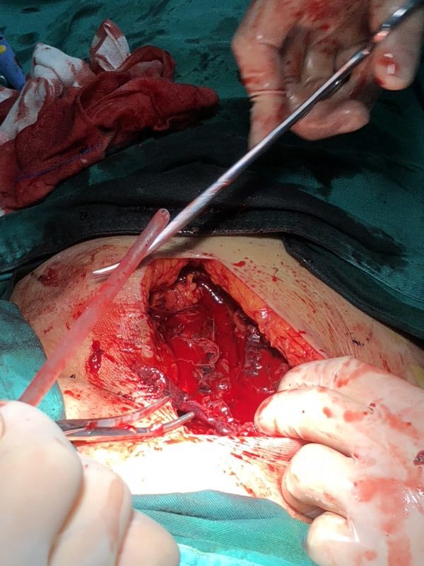 巨大股动脉假性动脉瘤切开修补,血肿清除 - 好大夫在线