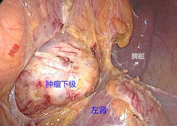 儿童腹膜后肿瘤图片