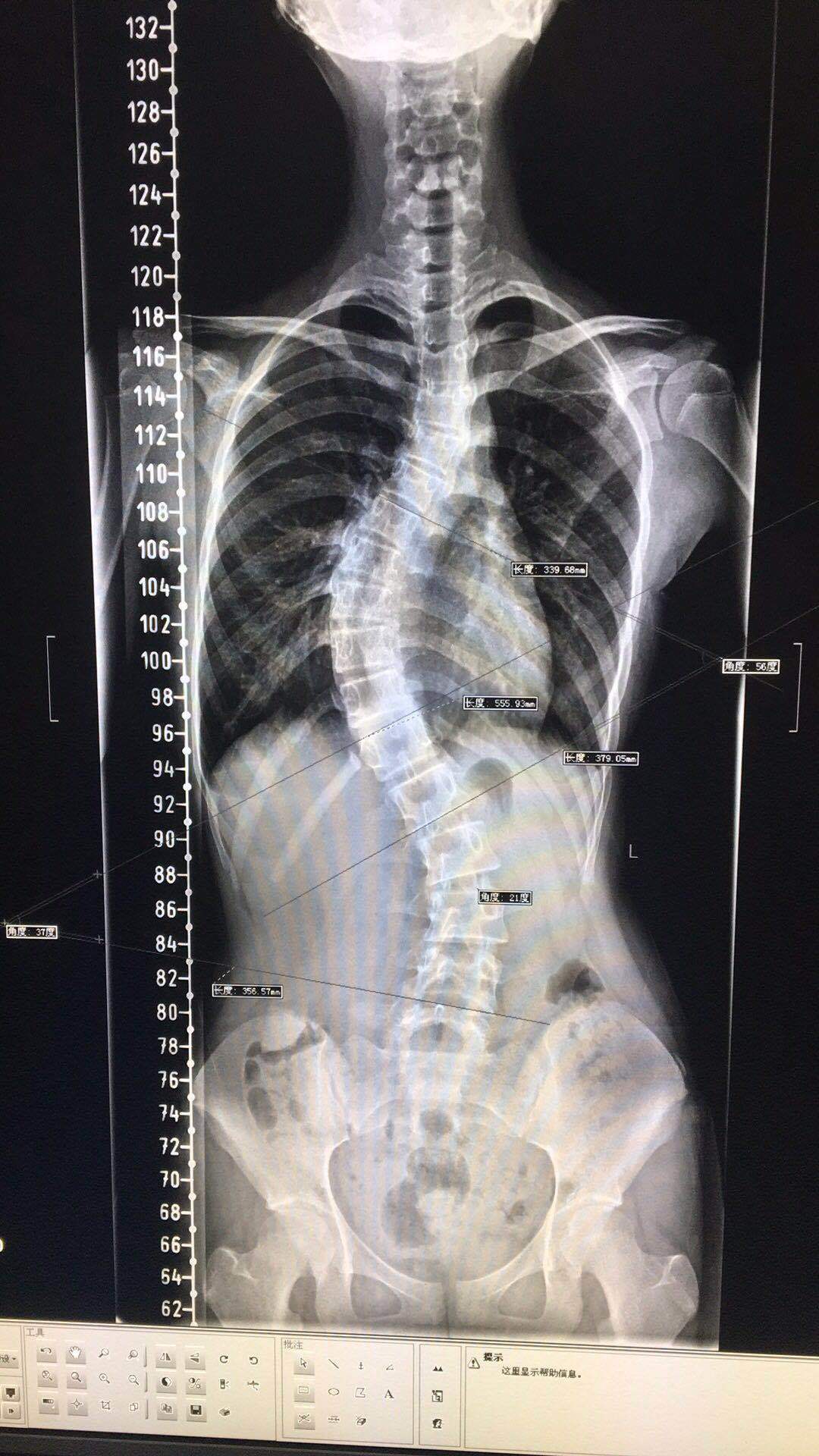 特發性脊柱側彎