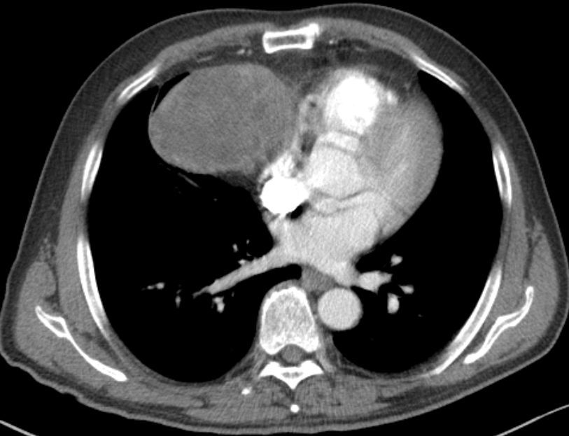 胸腺囊腫與胸腺瘤區別是什麼需要手術嗎thymiccyst