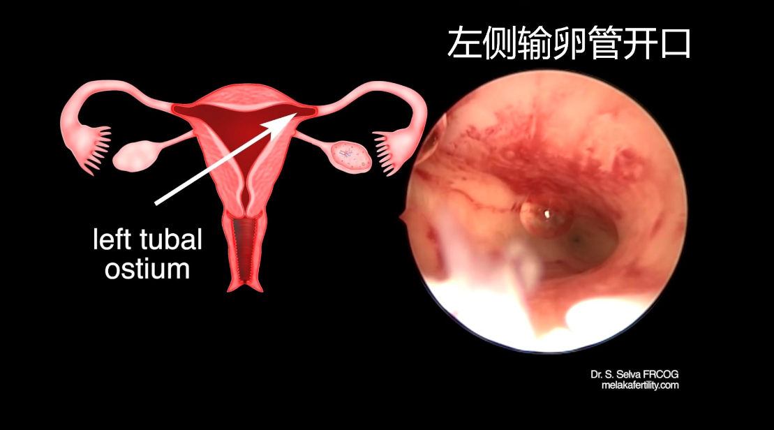 妇科宫腔镜手术 