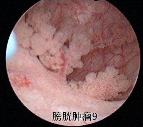 女性膀胱肿瘤早期症状图片