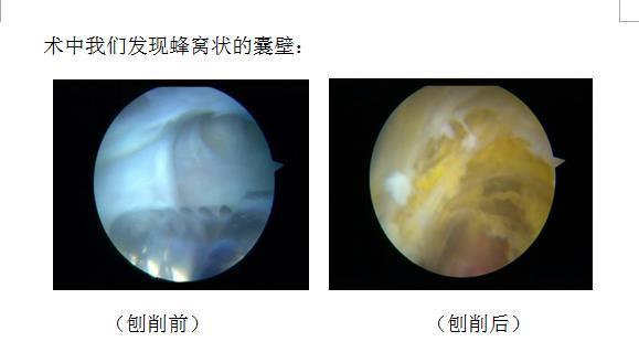 腘窝囊肿你还需要动刀子切吗?