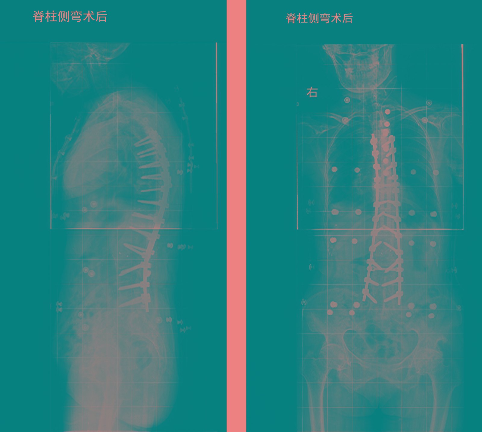 术后片子.jpg