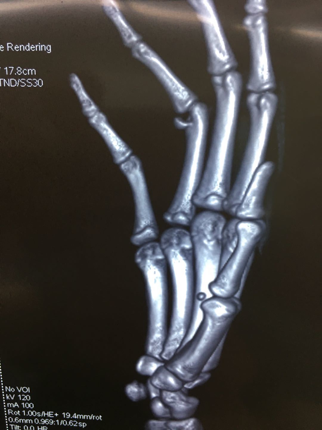 "手指近节远端hoffa骨折"一例报告 - 好大夫在线