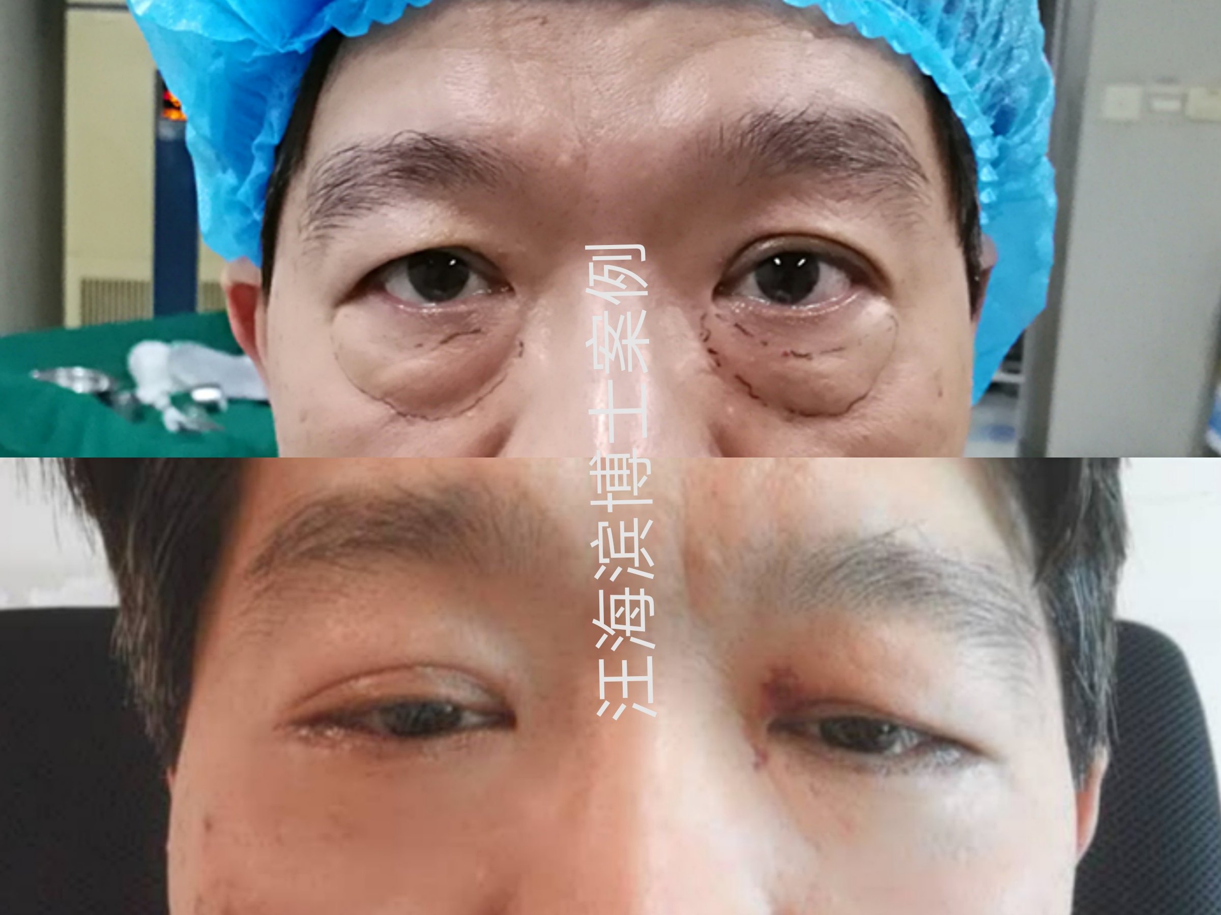 眼周年轻化手术之眶隔脂肪释放_去眼袋_去眼袋治疗介绍 - 好大夫在线