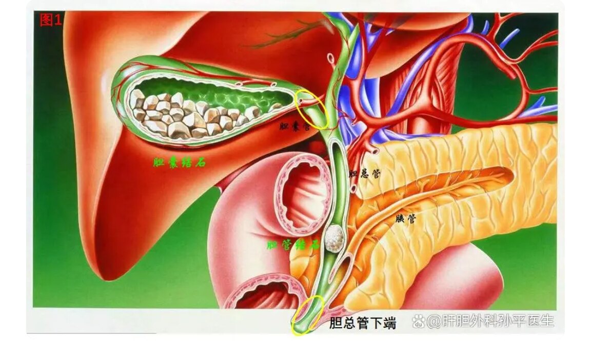 胆管炎有哪些症状和表现?_胆管炎_症状表现_日常注意事项 - 好大夫在线