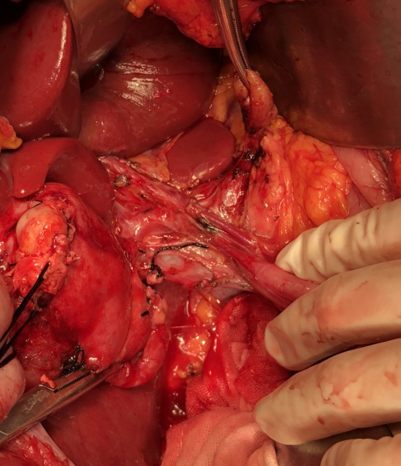 肝胆胰肿瘤低龄化趋势来临 - 好大夫在线