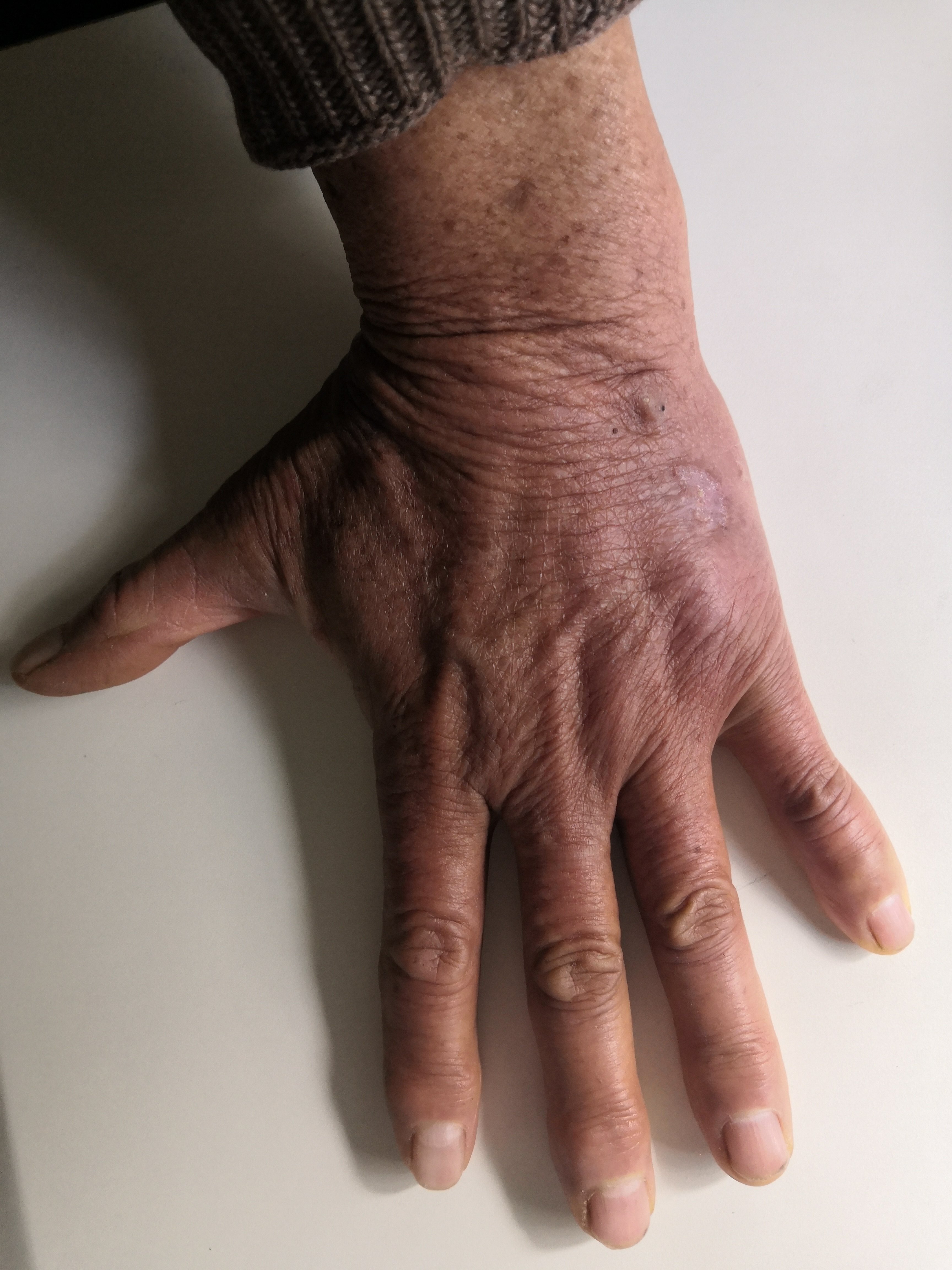 手背皮癌早期表皮图样图片