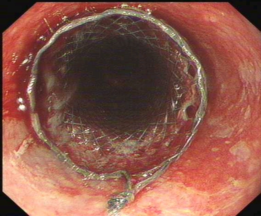 食管阻塞痛,吐,胀,闭典型的堵塞症状.